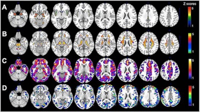 (A) MRI gray-matter volumes. (B) MRI white-matter volumes. (C) Pittsburgh compound B-PET beta-amyloid deposition. (D) FDG-PET glucose metabolism. Statistical parametric maps (SPMs) displaying brain regions showing Alzheimer's disease biomarker abnormalities in women versus men are represented on different color-coded scales after being thresholded to standardized z scores: 1 < z < 5, where z > 3 corresponds to p < 0.05 family-wise error corrected. All SPMs are displayed onto a standardized MR image. Image courtesy of Neurology, the medical journal of the American Academy of Neurology.