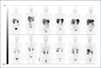 Comparison of whole-body maximum-intensity projections in six representative patients (patients 7, 8, 11, 14, 27, and 29 from left to right). Physiologic uptake is seen at pituitary gland, salivary glands, thyroids, adrenal glands, spleen (splenectomy in patients 7 and 8), and bowel on Ga‑68‑DOTATATE maximum-intensity projections (top). However, these normal organs show no uptake or very mild uptake on Ga-68-DOTA-JR11 maximum-intensity projections (bottom). In addition, Ga-68-DOTA-JR11 depicts more liver lesions than Ga-68-DOTATATE, with lower liver background. Image courtesy of the Journal of Nuclear Medicine.