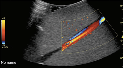 Example screenshot for poststenotic flow. Image courtesy of the RSNA.