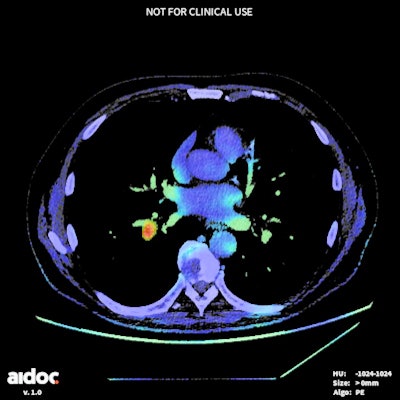 Color map of CT image flagged by AI software as a positive study for PE. The 59-year-old man, who was undergoing pancreatic cancer restaging, was found to have a segmental PE. Image courtesy of Dr. Anna Bader.
