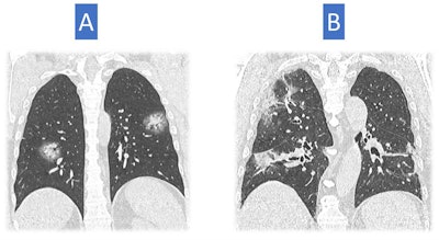 Image A shows larger opacities rounded in shape and some consolidation with a halo of ground glass. This sign has been described in COVID-19 cases. Consolidation is also present in image B, but the consolidation looks a bit different with architectural distortion, consistent with an organizing phase of COVID-19 pneumonia. These show a later stage of pneumonia than in the first three examples. Image courtesy of Dr. Nicola Sverzellati.