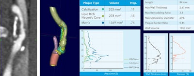 At left is a CT scan of the carotid artery. On the right, Elucid Bio's vascuCAP software transforms the scan into a 3D visualization and quantitation of plaque tissue composition and structural measurements. vascuCAP was validated in the CRISP trial to inform highly accurate prediction of major adverse neurological events such as stroke. Image courtesy of Elucid Bio.