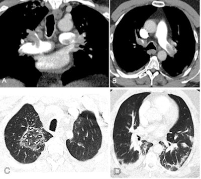 A COVID-19-positive patient with bilateral pulmonary emboli had D-dimer of > 10,000. A: Coronal CTPA image identifies bilateral pulmonary emboli that involve the left main pulmonary artery, distal right main pulmonary artery, right upper lobe pulmonary artery, and proximal segmental vessels. B: On an axial CPTA image, there is an embolus present in the left main and right upper lobe pulmonary arteries extending into the bilateral anterior segmental artery. C: A ground-glass opacity is present in the right upper lobe centrally with a reversed halo appearance, peripheral dense area, and central ground-glass opacity attributed to lung involvement from COVID-19. D: Axial image through the lung base demonstrates basilar consolidation compatible with COVID-19. Images and caption courtesy of the RSNA.