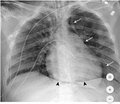 18-year-old man without significant medical history was intubated five days after admission and developed pneumomediastinum and pneumopericardium the same day. Frontal chest radiograph depicts mediastinal air bilaterally (white arrows). The 'continuous diaphragm sign' (black arrowheads) indicates air beneath the heart. Note diffuse hazy interstitial lung markings. Image and caption courtesy of the RSNA.