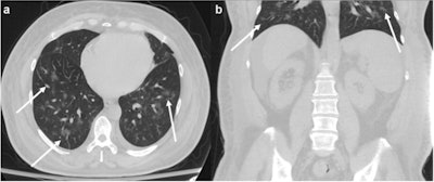 A 58-year-old male presenting with abdominal pain for seven days, who was subsequently discovered to be COVID-19 positive. (a) Axial and (b) coronal CT at the level of the lung bases show multifocal bilateral ground-glass opacities with a rounded morphology (arrows), many of which are peripheral in distribution. This patient was hospitalized and ultimately died 10 days later from respiratory failure related to COVID-19. Images and caption courtesy of European Radiology.