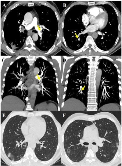 63-year-old male after 17 days of hospitalization without respiratory support and sudden increase of D-dimer value. The images show pulmonary thromboembolism in the lobar arteries for the left lower lobe (yellow arrow, A) and in the segmental arteries for the right lower lobe (yellow arrows, B), confirmed by maximum intensity projection reconstructions (yellow arrows, C and D). Lung parenchyma is characterized by some peripheral subpleural bilateral ground-glass opacities and consolidations (E, F). Images and caption courtesy of the RSNA.