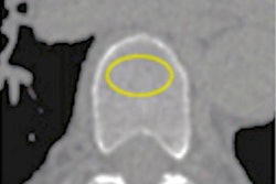 2020 07 13 23 43 5552 2020 07 14 Cardiac Ct Osteoporosis Figure1 3 20200713232056