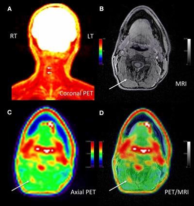 Adult male with decades of right neck pain, discomfort, and tightening following birth injury. The patient had failed multiple standard therapeutic maneuvers before presenting for F-18 FDG PET/MRI. Images show abnormally elevated FDG uptake (white arrows; SUVmax = 1.2) observed in a linear pattern in the space in the posterolateral right neck, between the oblique capitis inferior and the semispinalis capitis muscles, where the greater occipital nerve resides. By comparison, the same region on the contralateral, asymptomatic side of the neck has an SUVmax = 0.7. This result encouraged a surgeon to explore the area. The surgeon ultimately found a collection of small arteries wrapped around the nerve in this location. The small arteries underwent lysis by the surgeon and the patient reported tremendous relief of symptoms. (A) Coronal thick slab MIP [maximum intensity projection] of F-18 FDG PET. (B) Axial LAVA [Dixon liver acquisition with volume acquisition] Flex MRI through the cervical spine. (C) Axial PET at the same slice as the axial MRI. (D) Fused axial PET/MRI. Image courtesy of Peter Cipriano of Stanford University; caption courtesy of SNMMI.