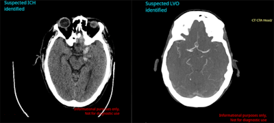 Avicenna.ai's Cina Head software can automatically detect and triage intracranial hemorrhage and large-vessel occlusion on emergency room CT scans. Image courtesy of Avicenna.ai.