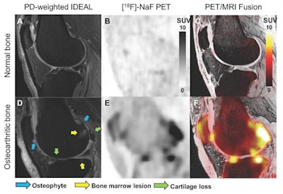 Representative structural MRI image (proton-density-weighted IDEAL [iterative decomposition of water and fat with echo asymmetry and least-squares estimation] image, A and D), 18F-NaF PET standardized uptake value images (B and E), and PET/MR fusion images (C and F) of a healthy knee and a knee with osteoarthritis. MOAKS scoring of MR images was used to identify the size of osteophytes, bone marrow lesions, and cartilage loss within various bone regions in the patella, tibia, and femur. Arrows highlight bone regions with osteophytes in blue, bone marrow lesions in yellow, and cartilage loss in green. Image courtesy of Lauren Watkins, et al, Stanford University.