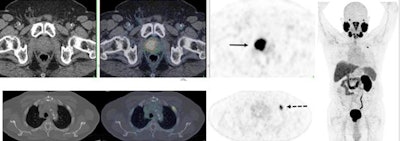 PSMA-PET/CT accurately detects recurrent prostate cancer in 67-year-old man. F-18 DCFPyL-PSMA PET/CT shows extensive, intensely PSMA-avid local recurrence in prostate (bottom row; solid arrow) in keeping with known tumor recurrence in the prostate. Right: PET shows extensive, intensely PSMA-avid local recurrence in prostate (top row; solid arrow) and a solitary bone metastasis in left rib two (bottom row; dotted arrow). Image courtesy of Dr. Ur Metser of the University of Toronto; caption courtesy of the SNMMI.
