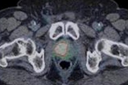 2020 07 14 23 23 6106 2020 07 13 Snmmi Pet Ct Prostate Thumb