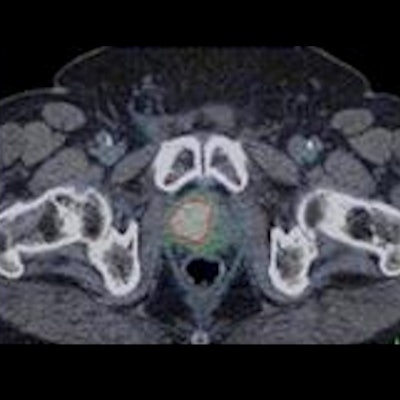 2020 07 14 23 23 6106 2020 07 13 Snmmi Pet Ct Prostate Thumb