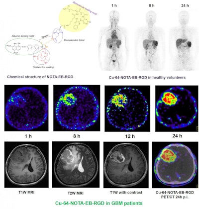 Maximum-intensity projection PET images of a healthy human volunteer injected with Cu-64-NOTA-EBRGD at 1, 8, and 24 hours after injection. Also, axial MRI and PET slices of glioblastoma patient injected with 64Cu-NOTA-EBRGD at different time points after injection. Images courtesy of Dr. Jingjing Zhang, PhD, et al, of Peking Union Medical College Hospital in Beijing, China, and Xiaoyuan Chen, PhD, et al, of the U.S. National Institute of Biomedical Imaging and Bioengineering (NIBIB).