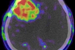 2020 07 15 00 25 0966 2020 07 14 Snmmi Radiotracer Glioblastoma 20200715001717
