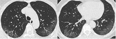 Peripheral ground-glass opacities are the predominant CT features, progressively replaced by linear consolidation, consistent with an organizing pneumonia pattern (six-day interval between the two CT scans). All images courtesy of Revel and previously presented at ECR 2020.