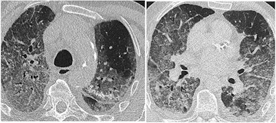 Major disease extent in an 89-year-old man with coronary artery disease. Advanced age, male gender, and preexisting comorbidities are the main risk factors for severe form of COVID-19 pneumonia and poor outcome.