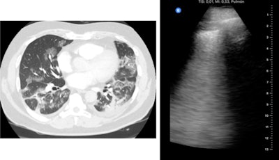 Ground glass on CT (left). Confluent B-lines on ultrasound (right). All images courtesy of Dr. Yale Tung Chen.