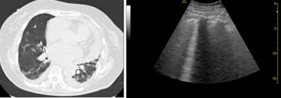 Septal thickening and pleural-pericardial effusion on CT (left). B-lines on ultrasound (right).
