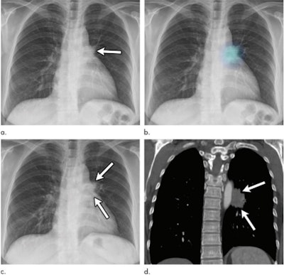 Images in a 52-year-old woman with a 10 pack-year history of smoking. (a) Initial chest radiograph shows a 2.4-cm nodule (arrow) overlapped by left hilar shadow. This lesion was undetected on the original report. (b) The deep learning-based automatic detection algorithm (DLAD) correctly detected this lesion with a probability value of 35%. Without DLAD, only two observers correctly detected the lesion; however, with DLAD, all nine observers detected the lesion and recommended chest CT for further evaluation. (c) Follow-up chest radiograph at time of diagnosis shows interval increase in lesion (arrows). (d) Follow-up chest CT image at time of diagnosis shows enhancing mass in left lower lobe (arrows). Patient was diagnosed with stage IV lung adenocarcinoma as bone metastasis was observed. The time between the initially overlooked chest radiograph and pathologic diagnosis was 447 days. Images and caption courtesy of the RSNA.