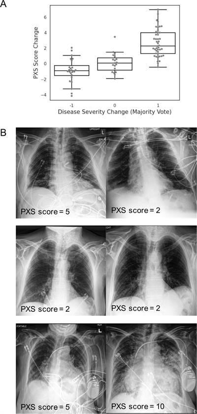 Siamese neural network-based pulmonary x-ray severity (PXS) score can be used to assess longitudinal change in radiographic disease severity over time in COVID-19 patients. (A) Boxplot shows the PXS score correlates with majority vote change in pulmonary disease severity (ρ = 0.74, p < 0.001), where -1, 0, and 1 indicate decreased, unchanged, and increased severity in longitudinal chest radiograph pairs, assigned by three independent raters (two thoracic radiologists, one in-training radiologist). The boxplot boxes indicate the median and interquartile range (IQR), with whiskers extending to points within 1.5 IQRs of the IQR boundaries. (B) Examples of PXS score evaluation of longitudinal change in three patients with COVID-19. Image and caption courtesy of Radiology: Artificial Intelligence.