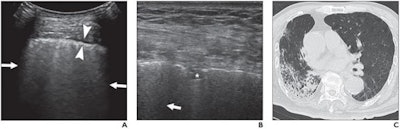 (A) Lung ultrasound image obtained with a convex probe. The outer arrows show confluent B-lines. The middle arrowheads point to a thickened pleural line. (B) Lung ultrasound image obtained with a linear probe. The arrow points to a B-line. The star denotes a patchy pulmonary consolidation. (C) Chest CT image showing reticular and interlobular septal thickening and patchy, focal opacities associated with architectural distortion. Image courtesy of the American Journal of Roentgenology.