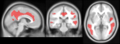 PET images show significant negative associations between PiB and FDG in the cingulate, temporal cortex, parietal cortex and precuneus. Image set courtesy of Journal of Nuclear Medicine (JNM, May 1, 2020; vol. 61: Supplement 1).