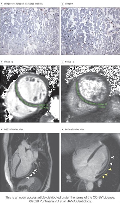High-sensitivity troponin T level on the day of cardiac MRI was 17.8 pg/mL. The patient recovered at home from COVID-19 illness with minimal symptoms, which included loss of smell and taste and only mildly increased temperature lasting two days. There were no known previous conditions or regular medication use. Histology revealed intracellular edema as enlarged cardiomyocytes with no evidence of interstitial or replacement fibrosis. (A and B) Immunohistochemical staining revealed acute lymphocytic infiltration (lymphocyte function-associated antigen 1 and activated lymphocyte T antigen CD45R0), as well as activated intercellular adhesion molecule 1. (C and D) Cardiac MRI revealed enlarged volumes in myocardial mapping acquisitions, including significantly raised native T1 and native T2. (E and F) Pericardial effusion and enhancement (yellow arrowheads) and epicardial and intramyocardial enhancement (white arrowheads) were seen on late gadolinium enhancement (LGE) acquisition. Images and caption courtesy of JAMA Cardiology.