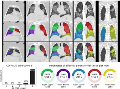 CO-RADS and CT Severity Score (CTSS) predictions for a COVID-19 positive case with extensive parenchymal involvement. A 73-year-old woman with positive RT-PCR test result. Noncontrast CT scan in coronal view (top row), overlaid with the automatic lobe segmentation (middle row) and the detected areas of abnormal parenchymal lung tissue (bottom row). This figure also shows the probabilities that the artificial intelligence model assigned to each CO-RADS category (bottom left), and the computed percentages of affected parenchymal tissue and the corresponding CTSS per lobe per lobe (bottom right). The eight observers scored this case 3x CO-RADS 3, 1x CO-RADS 4 and 4x CO-RADS 5. Image and caption courtesy of the RSNA.