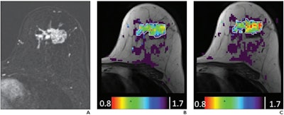 61-year-old woman with grade 3 invasive ductal carcinoma of no special type and ductal carcinoma in situ mass lesion. Axial dynamic contrast-enhanced subtracted image (A) and directional diffusion coefficient λ1 parametric maps (B and C) overlaid on T1-weighted image of central slice with unenhanced (B) and contrast-enhanced (C) administration are shown. There is substantial contrast in λ1 map between normal tissue (purple, with λ1 ≥ 1.7 × 10–3 mm2/s) and cancer (green-yellow-blue, λ1 < 1.2 × 10–3 mm2/s). Lesion is manually delineated in B and C. Units in B and C are in mm2/s × 10–3. Images and caption courtesy of the American Roentgen Ray Society.