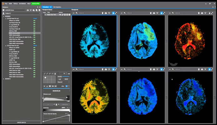 Random Walk debuts MRI analysis software at ISMRM 2020 | AuntMinnie