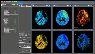 (Above) Example of novel parameter maps acquired with dVIEWR powered by MICE Toolkit, providing actionable information on tissue microstructure. (Below) Conventional diffusion MRI map, which is not able to resolve the same amount of actionable information from the MRI signal. Photo courtesy of Random Walk.