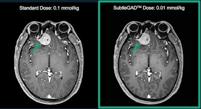 MRI images processed with Subtle's SubtleGAD algorithm at 10% of the original gadolinium dose. Image courtesy of Subtle Medical.