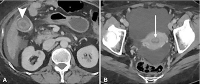 (A) Abdominal and (B) pelvic reconstructed CT images of a 66-year-old woman with cirrhosis obtained in the emergency department (ED) for abdominal pain show gallstones (arrowhead) detected by the off-hours in-house radiologist during night assignment at 12:30 a.m. This patient was discharged from the ED with a diagnosis of biliary colic. An abdominal division attending physician revised the report at 6:30 a.m. and noted that 'the endometrium is abnormally thickened up to 14 mm in the anteroposterior diameter with enhancing intracavitary observation' (arrow) and documented discussion with the ED. The ED contacted the patient later that day with recommendation and an appointment for outpatient gynecologic consultation. Over the subsequent six weeks, the patient underwent gynecologic consultation, pelvic ultrasound, and eventual hysteroscopic resection of a benign endometrial polyp. Image and caption courtesy of the RSNA.