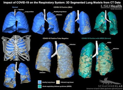 3D-segmented models of lung CT data show the distribution of COVID-19-related infection in the respiratory system. Image courtesy of LSU Health New Orleans.