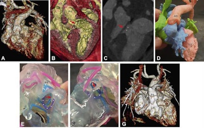 (A to C) CT images of a 4-month-old boy show a double-outlet right ventricle with a subpulmonary ventricular septal defect (asterisks). The aorta (AO) and approximately 70% of the pulmonary arterial trunk (PA) arise from the morphologically right ventricle (RV). The ventricular septal defect involves the uppermost part of the septum below the pulmonary valve. Noticeably, an abnormal papillary muscle (arrow) arises from the RV side of the ventricular septal defect margin and goes to the mitral valve, which is suggestive of the straddling mitral valve. Before 3D printing, the surgical strategy was equivocally palliative. (D) Blood pool and (E and F) endocardial wall modeling delineate the relevant anatomy, including the margin of the ventricular septal defect (asterisks on a purple ring), the pulmonary annulus (blue ring), and the abnormal papillary muscle (arrow). The surgical plan was changed to corrective after reviewing the 3D printout. (G) Postoperative CT shows the successful results of the arterial switch operation and the ventricular septal defect baffling. Images and caption courtesy of JACC: Cardiovascular Imaging.