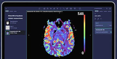 Quantitative rCBV map generated within Artery. Image courtesy of Imaging Biometrics.