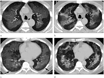 Electronic cigarette or vaping product use-associated lung injury in a 51-year-old man manifesting as an acute lung injury pattern at CT with subsequent organization. (a, c) Axial unenhanced CT images at presentation through (a) mid and (c) lower lungs show ground-glass opacity with subpleural sparing (arrows); this distribution was present in 45% of CT studies at presentation in our cohort (11). (b, d) Axial unenhanced CT images obtained six days later show ground-glass opacity has transitioned to consolidation and mild architectural distortion, consistent with developing organization. The patient was initially treated with antibiotics followed by corticosteroid therapy, with slow clinical improvement. Images and caption courtesy of the RSNA.
