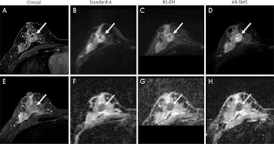 Images of a large lesion from a clinical full-protocol MRI (clinical MRI), standard single-shot spin-echo echo-planar imaging (Standard A), readout-segmented echo-planar imaging (RS-EPI), and axially reformatted-simultaneous multislice imaging (AR-SMS). The images in the clinical MRI column include (A) contrast-enhanced image and (E) T2-weighted image. The images in the alternative MRI protocol columns include (B-D) images with b value of 800 sec/mm2 and (F-H) apparent diffusion coefficient maps focused on a large contrast-enhanced lesion. Image courtesy of the RSNA.