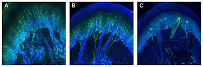 The images show small fibers in the skin of footpads of mice following a single injection of a human equivalent dose (1 mmol/kg BW) of saline (A), macrocyclic gadolinium-based contrast agent (GBCA) gadobutrol (B), and nonionic linear GBCA gadodiamide (C), visualized with laser ablation inductively coupled plasma-mass spectrometry. Compared to A, the number of small fibers is slightly reduced in B, while the number of small fibers is strongly reduced in C. Moreover, terminal axonal swellings are visible after the injection of gadodiamide in C. Figure courtesy of Investigative Radiology, derived from Invest Radiol, 2020 Aug;55(8):473-480.