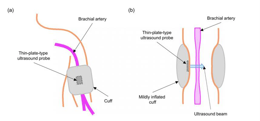 Blood Pressure Cuff Exploding Blood Pressure Cuff Diagram
