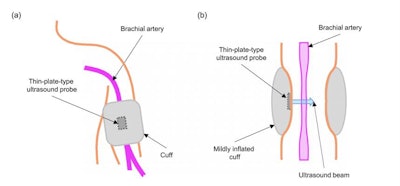 (A) Schematic illustration of the cuff and ultrasound probe wrapped around the upper arm and positioned over the brachial artery. (B) Longitudinal cross section illustration of the ultrasound probe and inflated cuff. When the cuff is inflated, the device tracks the ultrasonic dimension of the brachial artery. Image courtesy of Dr. Kazunori Uemura, PhD.