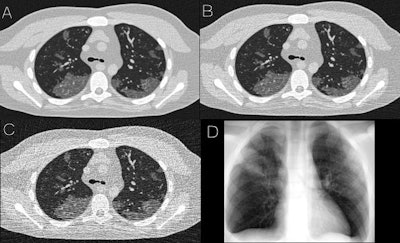 Simulated images of COVID-19 on 4D extended cardiac-torso phantom developed at Duke University, including simulated CT at 50 mAs (A), 25 mAs (B), and 5 mAs (C), as well as a simulated chest radiograph (D). Images and caption courtesy of the American Journal of Roentgenology.