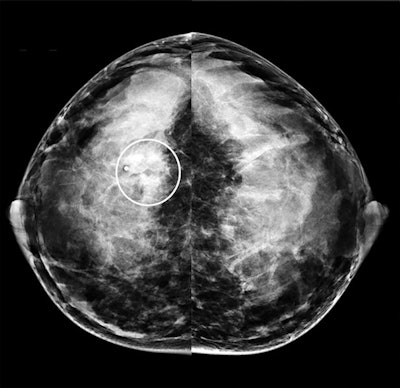 Craniocaudal mammogram from the same 40-year-old patient with invasive ductal carcinoma. The patient's mammogram images show a subtle, obscured mass at the site of the palpable abnormality (region of interest) with some associated amorphous calcifications.