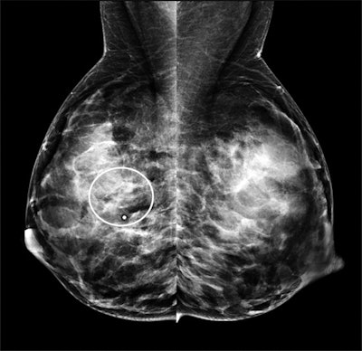 Mediolateral oblique mammogram from the same 40-year-old patient with invasive ductal carcinoma. Both mammograms depict heterogeneously dense breast tissue.