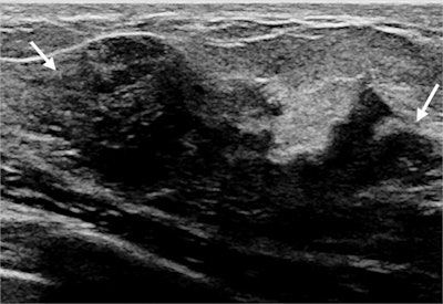 Imaging from a 40-year-old breastfeeding woman with a palpable lump in the right breast who was diagnosed with invasive ductal carcinoma. This targeted gray-scale ultrasound image shows a 2.4-cm hypoechoic irregular solid mass with indistinct margins (arrows) at the site of the palpable abnormality. All images courtesy of the RSNA.
