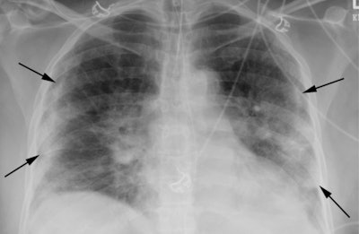 Characteristic chest x-ray of a 63-year-old female presenting with dyspnea and fever. Chest radiographic findings include bilateral 'patchy' and 'confluent, bandlike' ground-glass and consolidative opacity in a peripheral, mid-to-lower lung zone distribution (arrows). Image and caption courtesy of the RSNA.