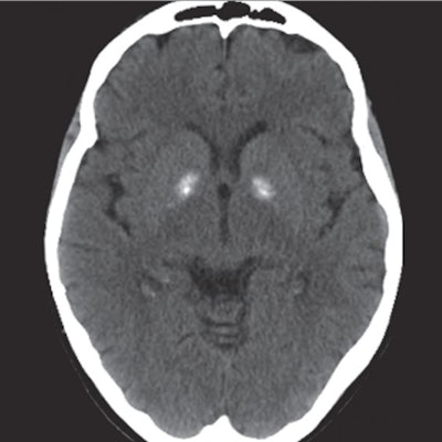 CT scan from a 69-year-old woman with neurological impairment after a trip to Cuba. Findings show bilateral hyperdensity of the globus pallidi. Image courtesy of JAMA Network.
