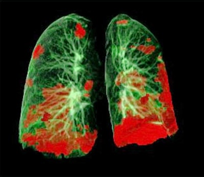 CT scan of patient's lungs, showing COVID-19 damage in red. Image courtesy of study co-author Dr. Gerlig Widmann, Medical University of Innsbruck.