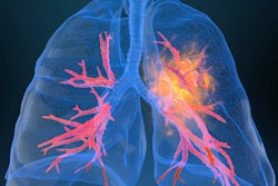 2020 09 08 22 00 6800 Lung Cancer2 400